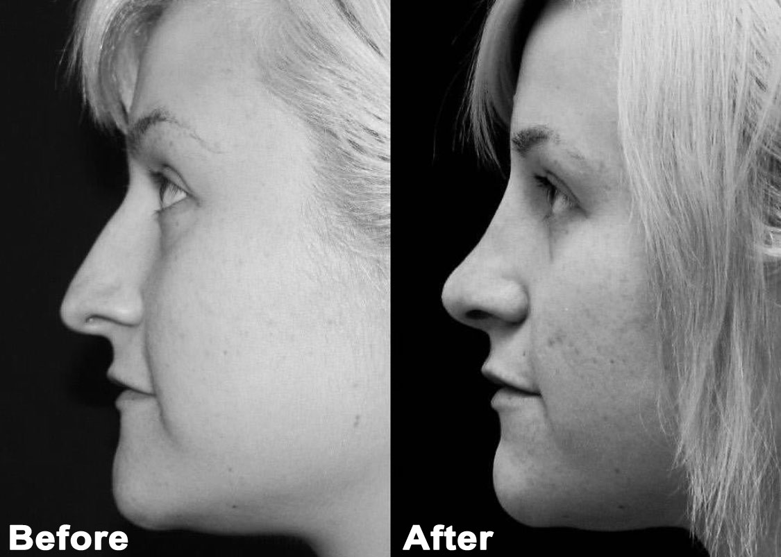 Nose Surgeon in Los Angeles, Best Rhinoplasty Surgeon in Los Angeles