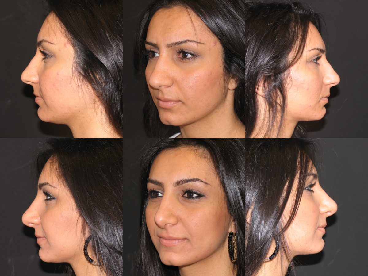 Nose Surgeon in Los Angeles, Best Rhinoplasty Surgeon in Los Angeles