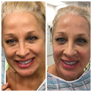 PRP With Microneedling - Calwest Surgical Institute